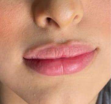 butterfly-lips-before