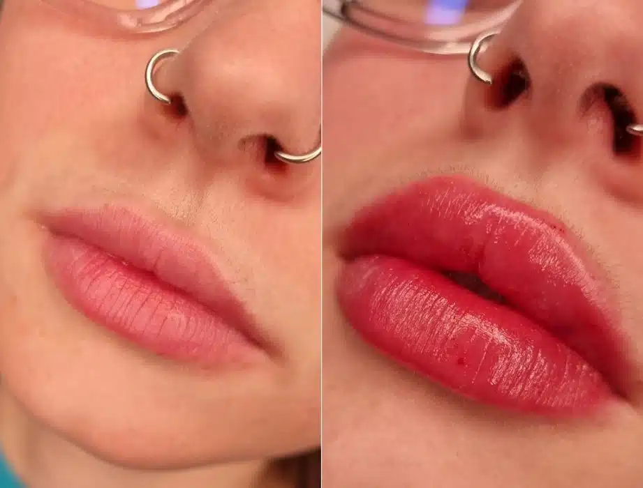 marire-buze-acid hialuronic